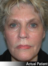 Eyelid Lift - Blepharoplasty Patient