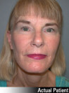 Facelift Patient