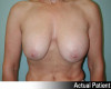 Breast Lift and Augmentation Patient