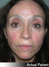 Eyelid Lift - Blepharoplasty Patient