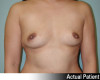 Breast Procedures Patient