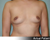 Breast Augmentation Patient