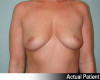 Breast Augmentation Patient