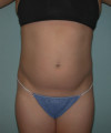 Liposuction Patient