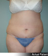 Tummy Tuck Patient