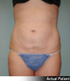 Liposuction Patient