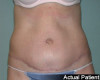 Tummy Tuck Patient