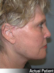 Patient # 48539 After Photo # 6