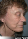 Patient # 56960 After Photo Thumbnail # 4