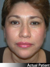 Facelift Patient