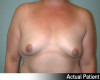 Breast Augmentation Patient