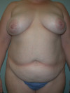 Tummy Tuck Patient