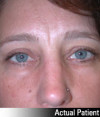 Eyelid Lift - Blepharoplasty Patient