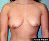 Breast Lift and Augmentation Patient