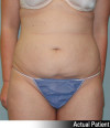 Liposuction Patient