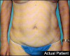 Tummy Tuck Patient