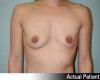 Breast Augmentation Patient