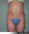 Liposuction Patient