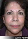 Facelift Patient