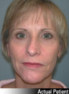 Facelift Patient