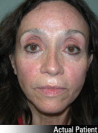 Facelift Patient