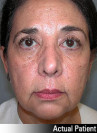 Facelift Patient