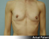 Breast Augmentation Patient