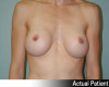 Breast Augmentation Patient