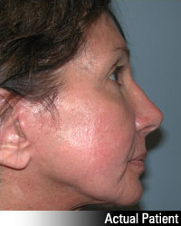 Patient # 21181 After Photo # 8