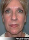 Facelift Patient