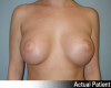 Breast Augmentation Patient