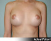 Breast Augmentation Patient