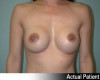 Breast Augmentation Patient