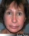 Facelift Patient