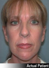 Facelift Patient