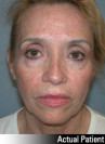 Brow Lift Patient