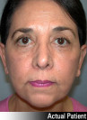 Facelift Patient