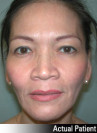 Eyelid Lift - Blepharoplasty Patient