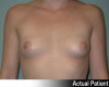 Breast Augmentation Patient