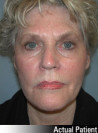 Facelift Patient