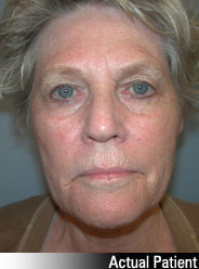 Patient # 39771 Before Photo # 1