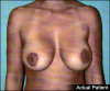 Breast Lift and Augmentation Patient