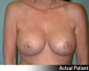 Breast Augmentation Patient