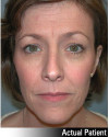 Brow Lift Patient