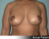 Breast Lift and Augmentation Patient