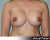 Breast Augmentation Patient