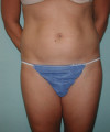 Tummy Tuck Patient