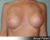 Breast Augmentation Patient