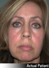 Eyelid Lift - Blepharoplasty Patient