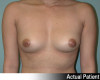 Breast Augmentation Patient